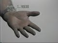 Traumatologia semiologia mano parte 1