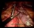 Gastric Sleeve (VSG)