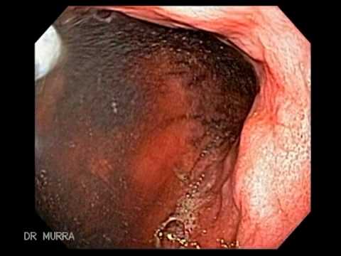 how to stop a g i bleed