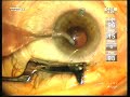 Phaco, Small pupil, IFIS, OzilŪ Phaco, Small pupil, IFIS, OzilŪ