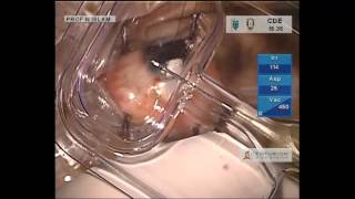  ExPress mini glaucoma shunt - Prof. M. Nazrul Islam