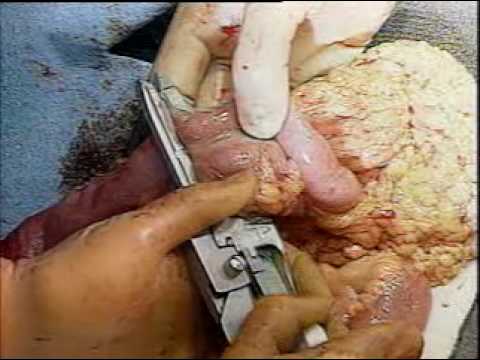 Colon Surgery - Right hemicolectomy colonic colon surgery resection and anstomosis of intestines repair cancer treatment cecal newgrowth GI G.I stapler stapling device T.I.A...