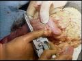 Right Hemicolectomy Surgery