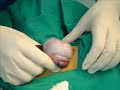 CIRUGIA CANINOS SEMINOMA CIRUGIA CANINOS SEMINOMA