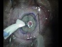 LASIK step by step LASIK step by step
