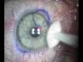 videos de LASIK step by step