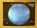 Die Implantation eines Herzschrittmachers Die Implantation eines Herzschrittmachers