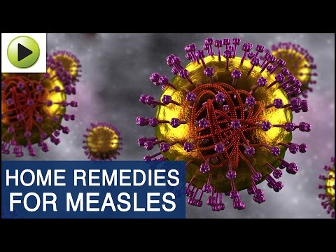 how to treat measles naturally
