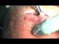 The Knee Infection (beware: quite disgusting)