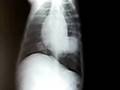 Jerry's Metronomic Protocol is Working!