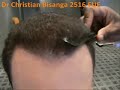 Dr Bisanga 2516 FUE 14 Months Post Op Video Dr Bisanga 2516 FUE 14 Months Post Op Video
