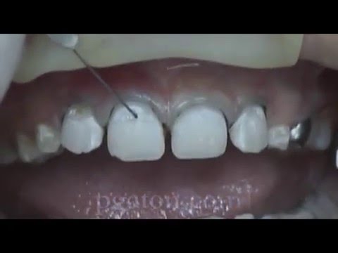 how to treat iv infiltration sites