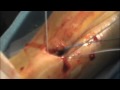 Minimally Invasive Achilles Repair Minimally Invasive Achilles Repair