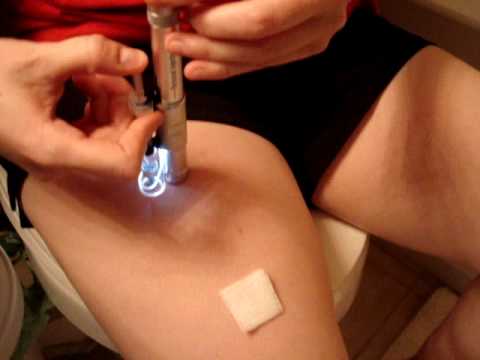 Avonex Injection using AutoInjector