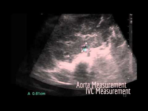 how to measure aorta on ultrasound