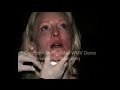 Live Restylane Injections by Dr. Jennifer Walden Live Restylane Injections by Dr. Jennifer Walden