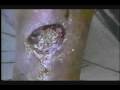 Ulcera Diabetica / Diabetic Ulcer