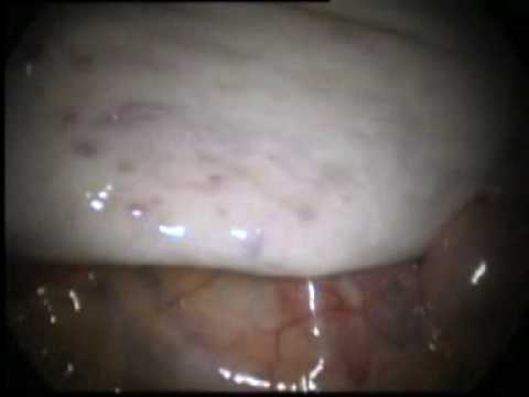 how to drain ovarian cyst