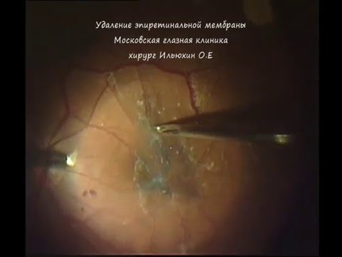Видео Эпиретинальная мембрана