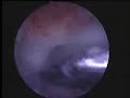 ????????????????? Impingement syndrome Acromioplasty ??????? ??????????????? ??????????