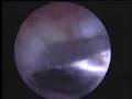 กระดูกทับเส้นเอ็น Impingement syndrome Acromioplasty ปวดไหล่ ผ่าตัดส่องกล้อง หัวไหล่ติด
