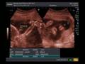 videos de Nossa filha Valentina 26 SEMANAS