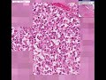 Histopathology Uterus--Leiomyosarcoma
