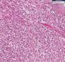 Histopathology Uterus--Leiomyosarcoma