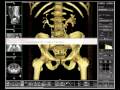 Tips &amp; Tricks Video: Creating a 3D CT Urography View