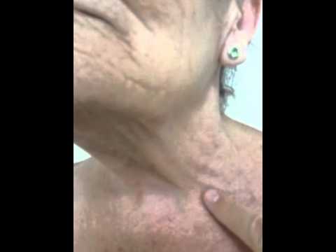 how to treat svc syndrome