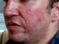 The Acne Practice  (Home Version Follow up Video)