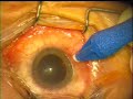 25 GAUGE VITRECTOMY