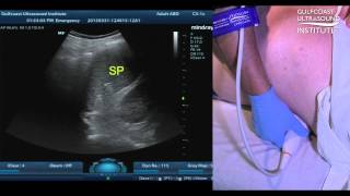 A Sonographer's Guide to Navigating the Spleen