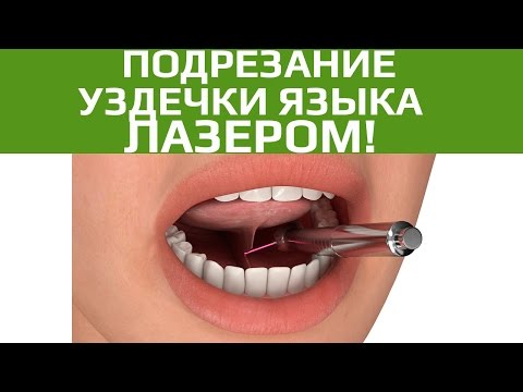 Подрезание уздечки языка и губы