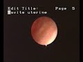 hysteroscopics-aspects-of-intra-uterine-myomas.html