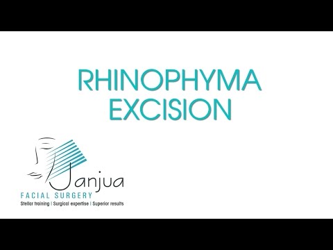 surgery - Patient undergoes Rhinophyma excision to remove large growth on nose which was causing difficulty breathing in addition to serious concerns about appearance.