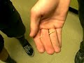 Splinter Through Finger