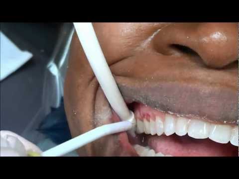 how to whiten dental glue