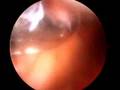 Arthroscopic Medial patella plication