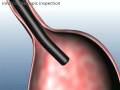 StomaphyX™ - Gastric Bypass Revision from Fort Worth LAPBAND