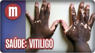 Saúde: Vitiligo