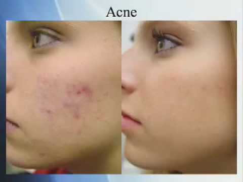 how to cure acne with vitamin d