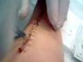 getting my staples out