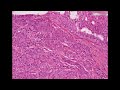 Histopathology Breast--Epithelial hyperplasia