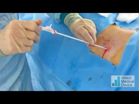 how to drain nephrostomy tube