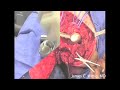 Osteosarcoma Proximal Humerus Part 4 of 6 Osteosarcoma Proximal Humerus Part 4 of 6