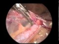 Application Of Robotically-Assisted and Laparoscopic Procedure in Pediatrics (2/2). Application Of Robotically-Assisted and Laparoscopic Procedure in Pediatrics (2/2).