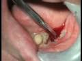 Dental Implant Complications