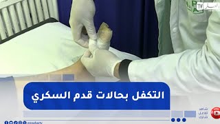 وحدات جديدة للتكفل بحالات قدم السكري المتعفنة