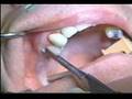 Sinus Augmentation